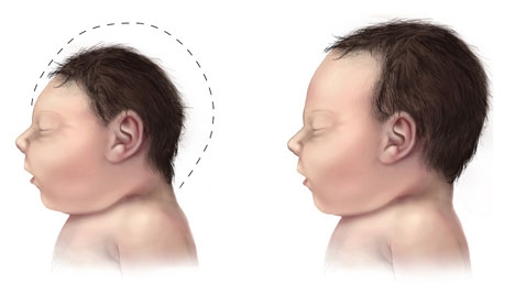 Zika-viruset kan orsaka missbildningar i skallen hos foster.