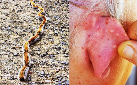 Så här såg mitt öra ut efter det att jag använt mina glasögon för att peta en pinjelarv tillrätta för fotografering. Foton: Bengt Sändh