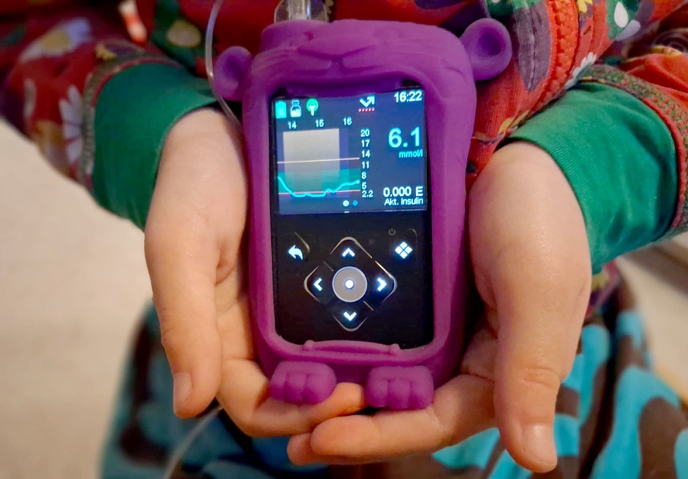 En avancerad insulinpump är ett oslagbart hjälpmedel för typ 1-diabetiker.