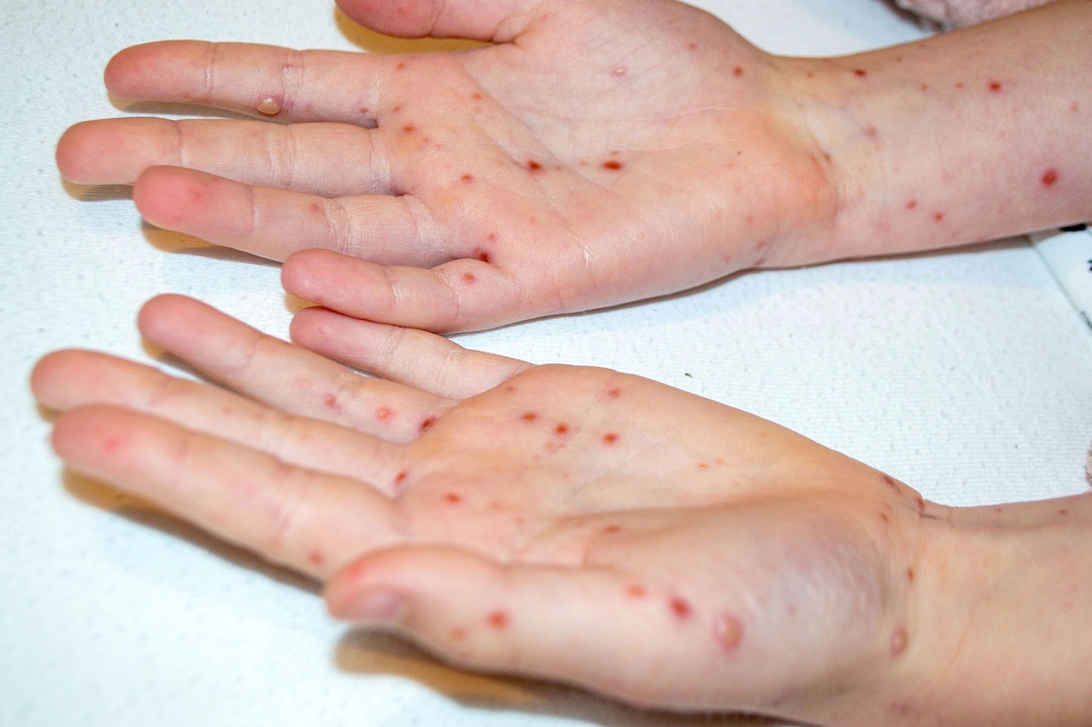 I Madrid har 24 fall bekr&auml;ftats p&aring; bara sex veckor, vilket &auml;r en fyrdubbling j&auml;mf&ouml;rt med hela f&ouml;rra &aring;ret. (Arkivbild)